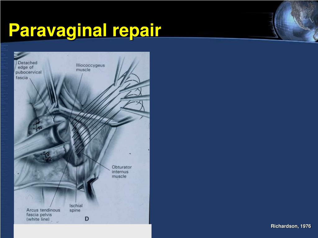 3rd and 4th Degree Perineal Laceration Repair YouTube