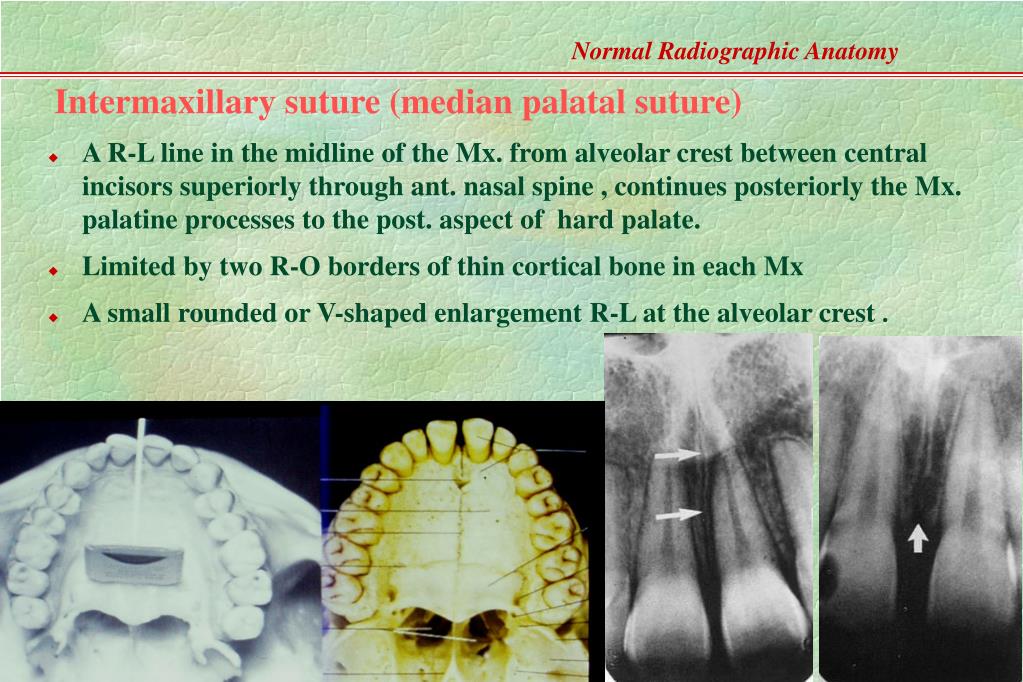 PPT Normal Radiographic Anatomy Based on Intraoral Films PowerPoint Presentation ID292169
