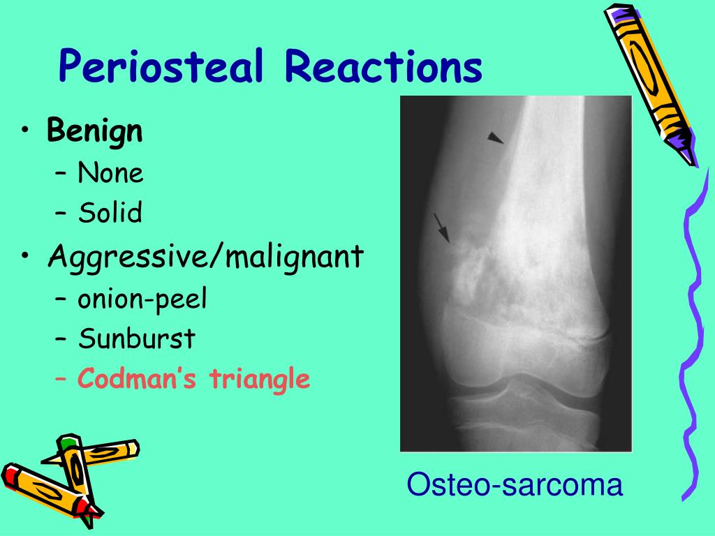 PPT BONE TUMORS PowerPoint Presentation, free download ID293167