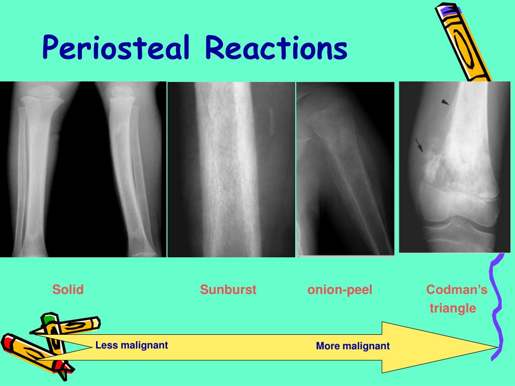PPT BONE TUMORS PowerPoint Presentation, free download ID293167