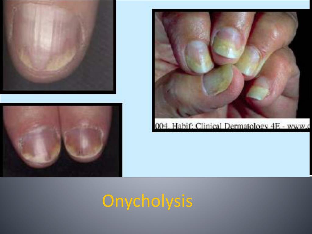 PPT Nail Disorders Clues to Systemic Disease PowerPoint Presentation