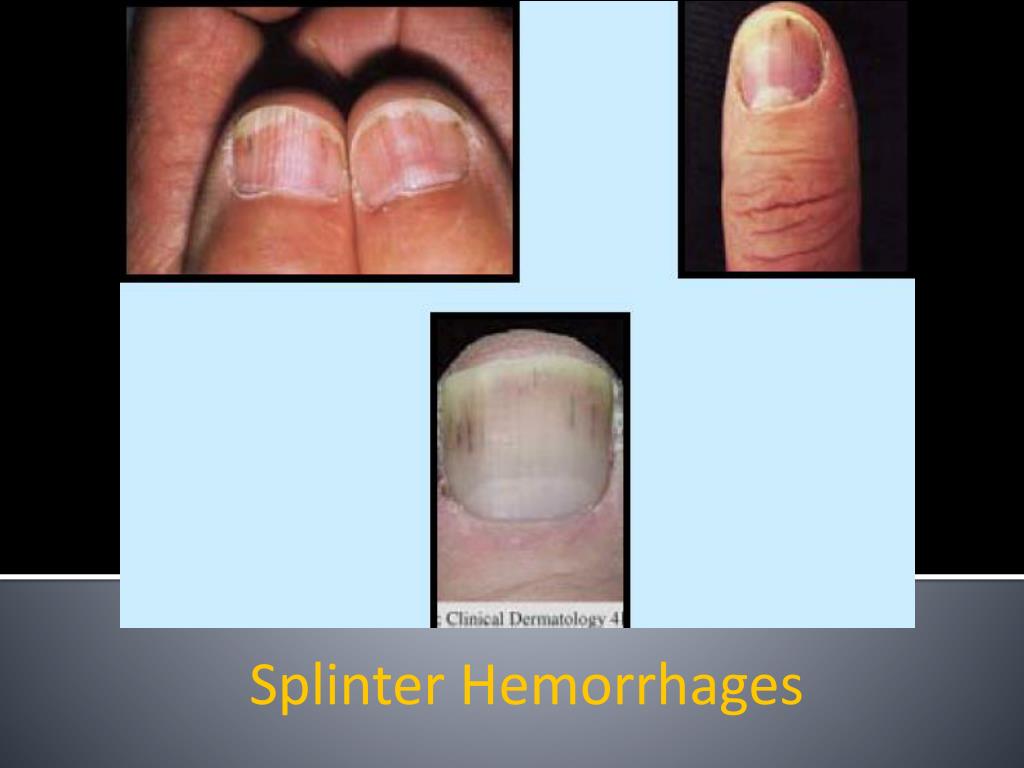 PPT Nail Disorders Clues to Systemic Disease PowerPoint Presentation