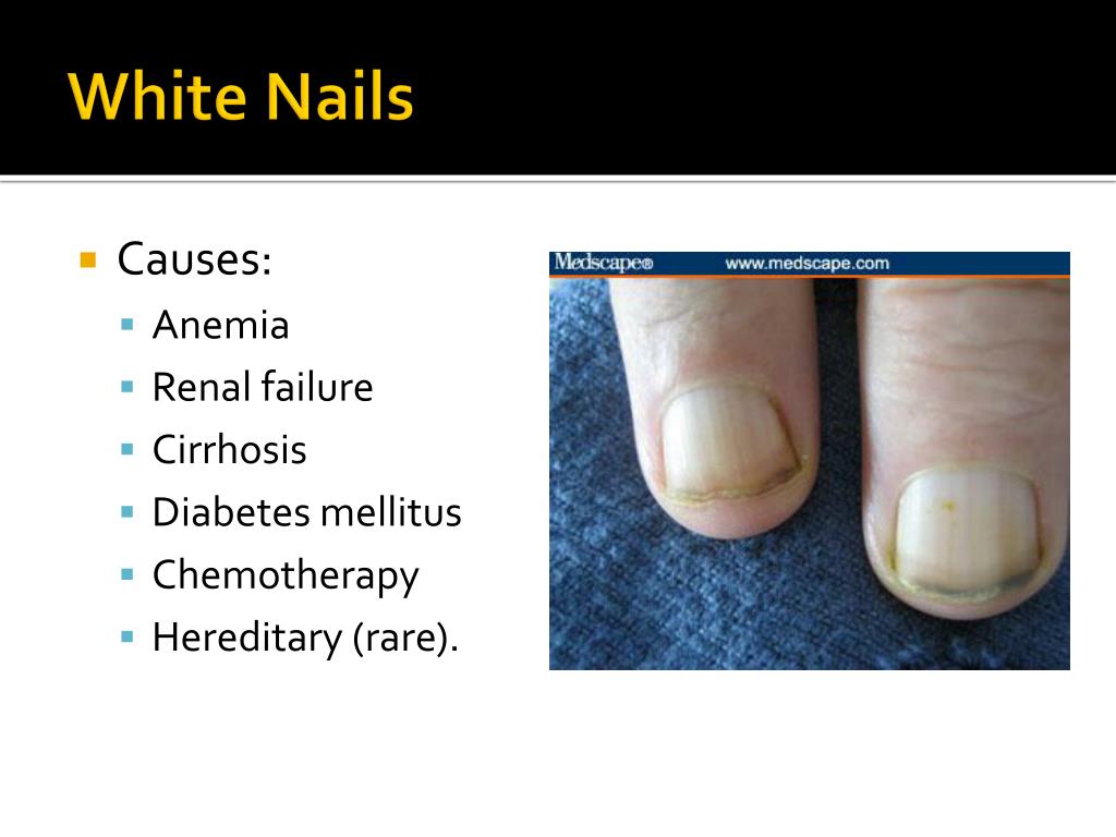 PPT Nail Disorders Clues to Systemic Disease PowerPoint Presentation ID294836