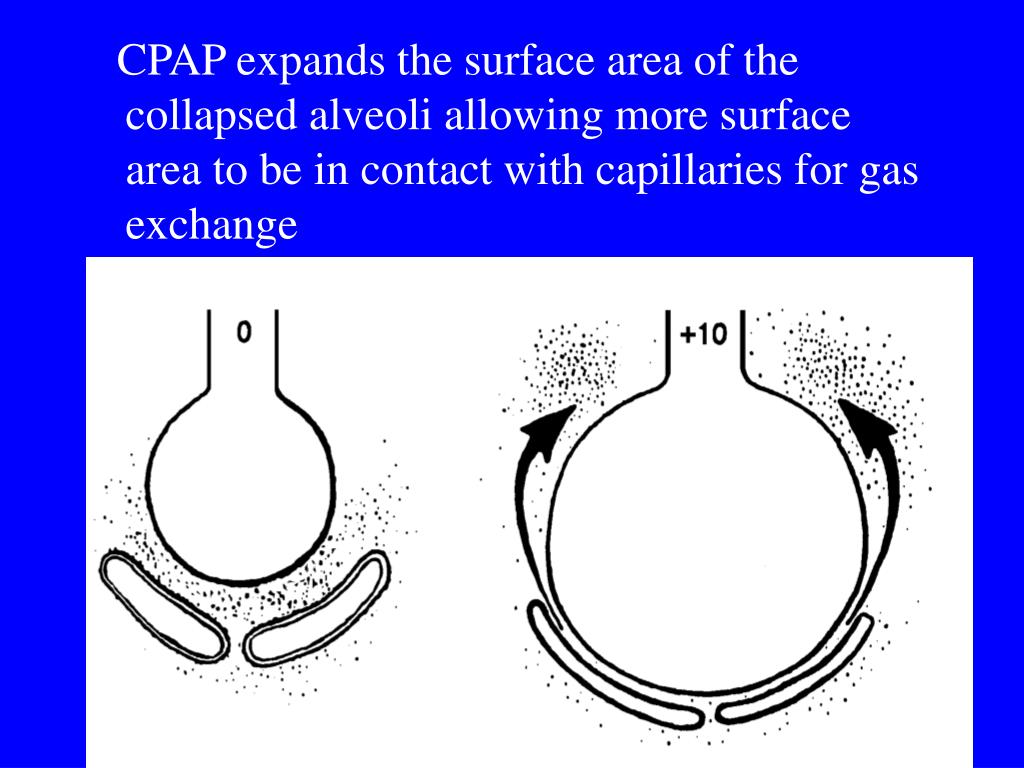 PPT Respiratory Emergencies CHF, Pulmonary Edema, COPD, Asthma CPAP