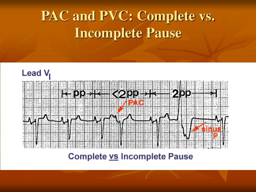 PPT ELECTROCARDIOGRAM PowerPoint Presentation, free download ID297761