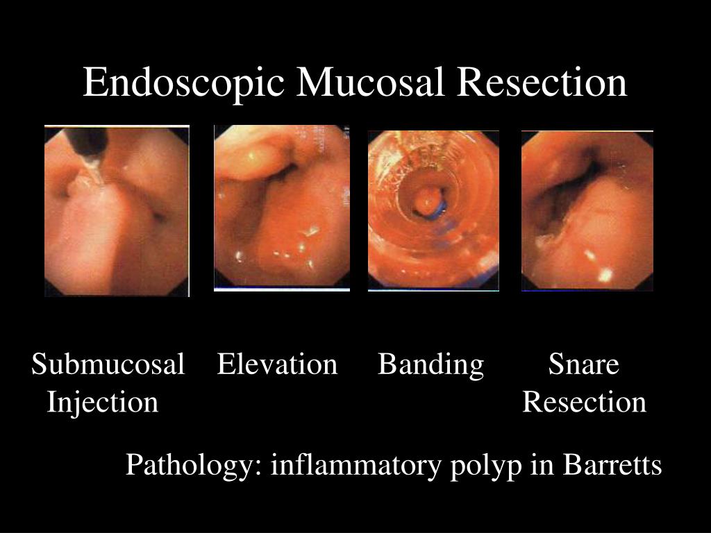 PPT Endoscopic Mucosal Resection PowerPoint Presentation, free