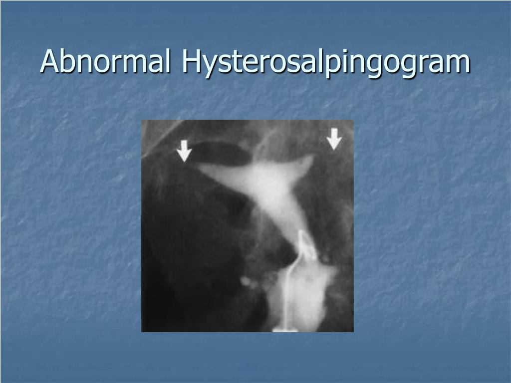 Fluoroscopy Hysterosalpingogram Cpt Code at Monica Ferguson blog