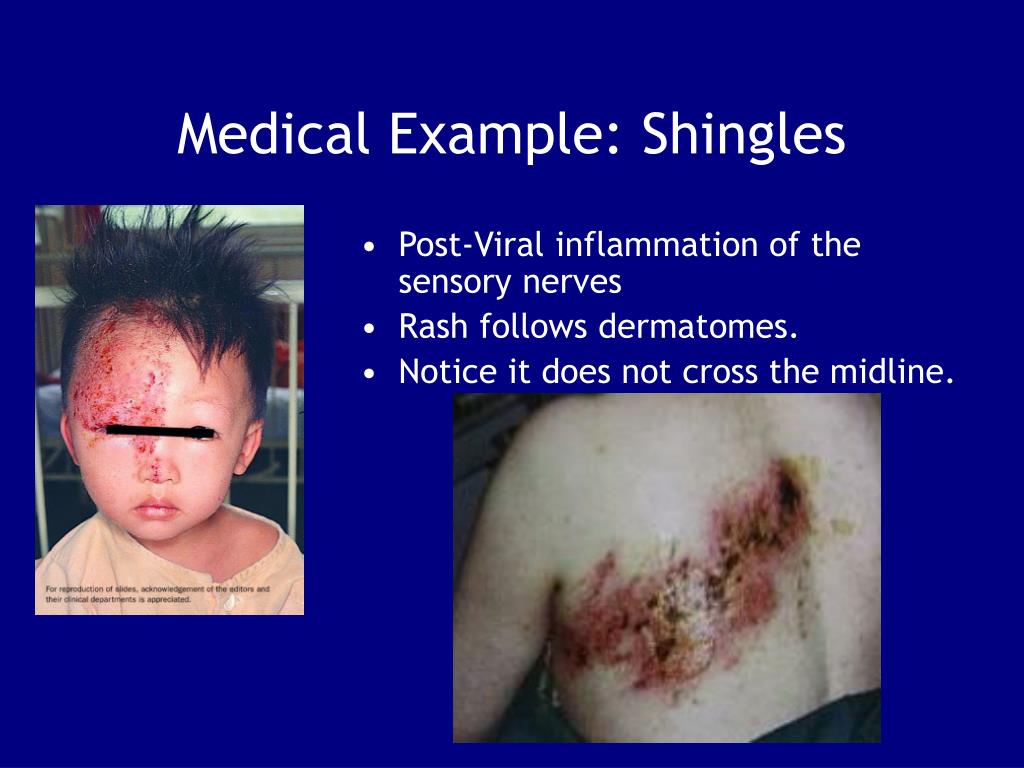 Shingles Nerve Pathways Diagram