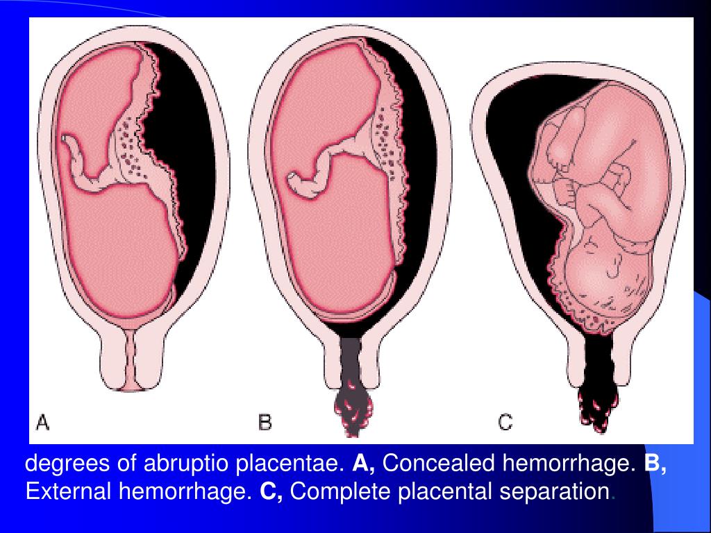 PPT Anesthesia for Obstetrics Department of anesthesiology Cui Xiao