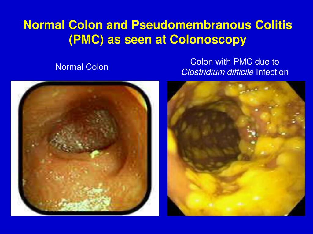 PPT Clostridium difficile Infection (CDI) Increasingly