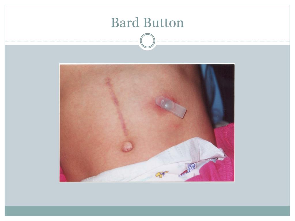 PPT Nursing Considerations for Enteral Tubes PowerPoint Presentation