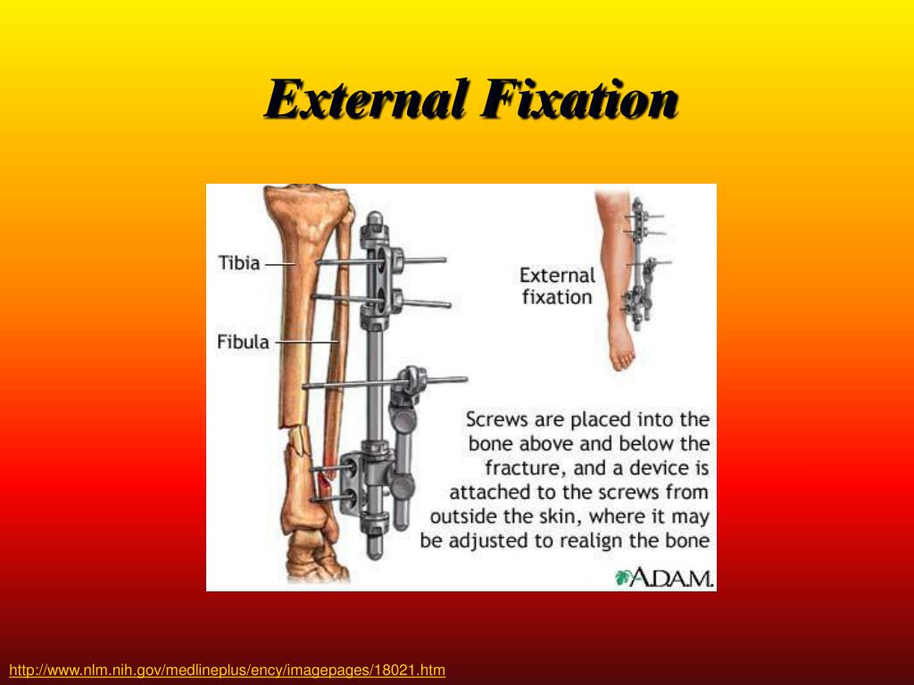 PPT Fracture Fixation Internal & External PowerPoint