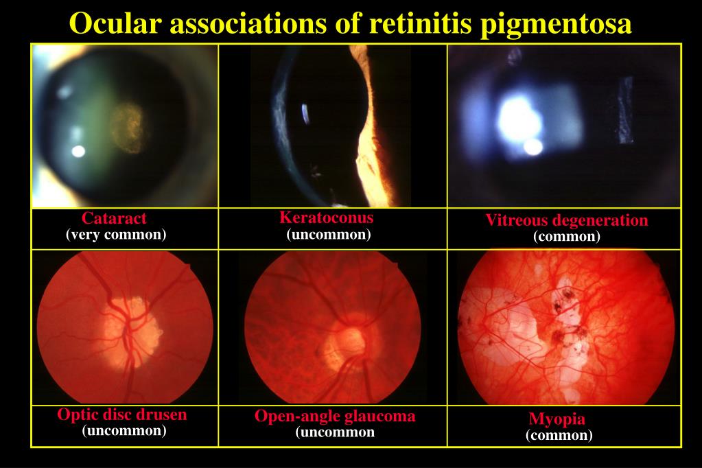 PPT HEREDITARY RETINAL DYSTROPHIES PowerPoint Presentation ID335032