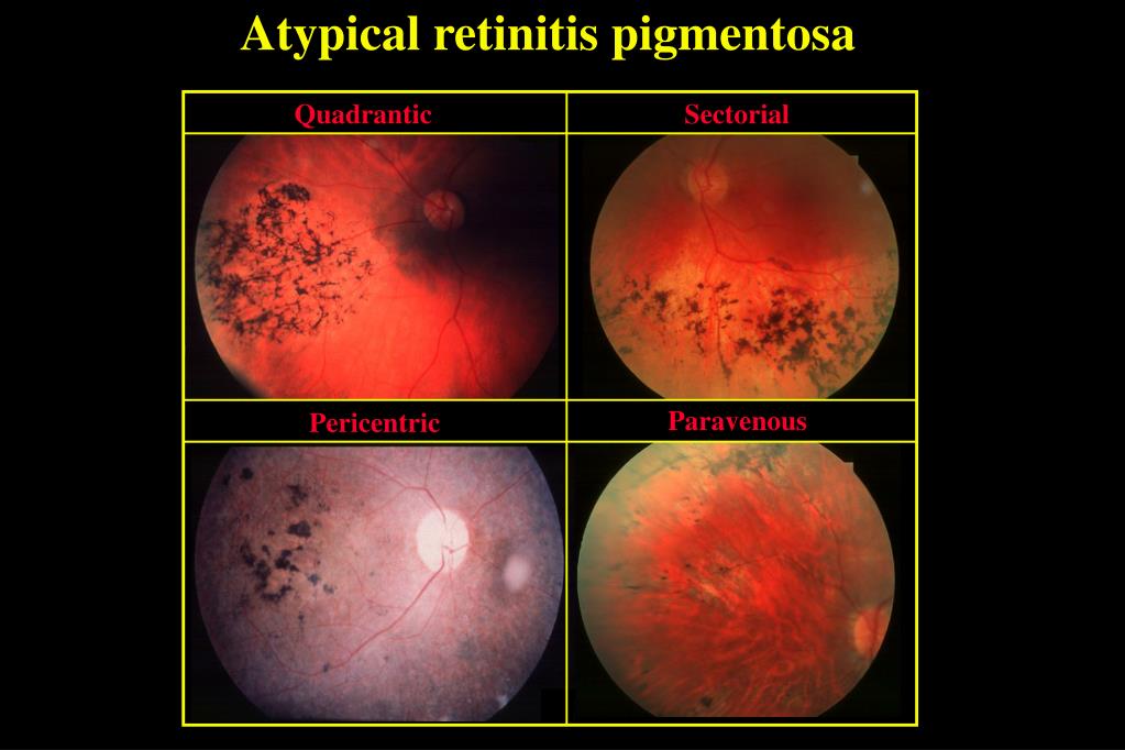 PPT HEREDITARY RETINAL DYSTROPHIES PowerPoint Presentation, free