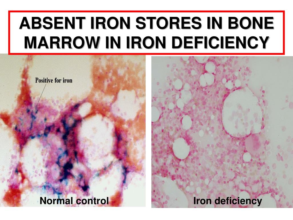 PPT IRON IN HEALTH AND DISEASE PowerPoint Presentation, free download