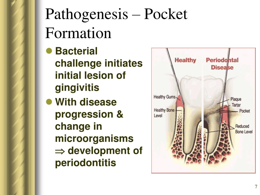 PPT Chronic Periodontitis PowerPoint Presentation, free download ID