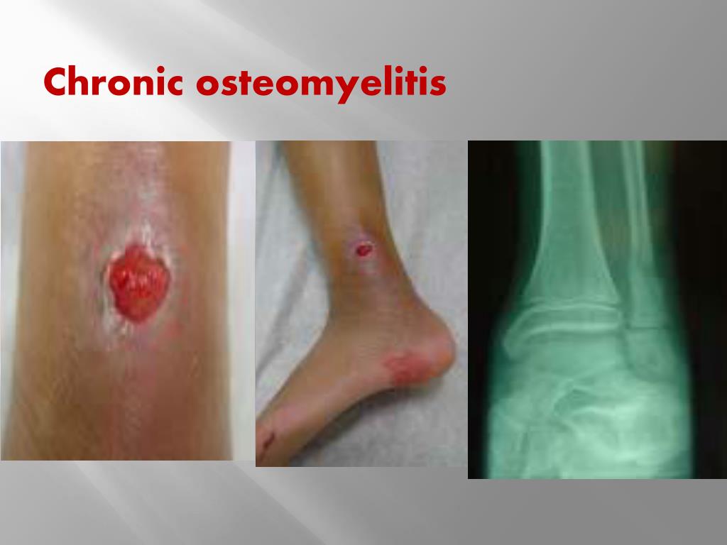 PPT Chronic nonspecific infection of bone and joint PowerPoint