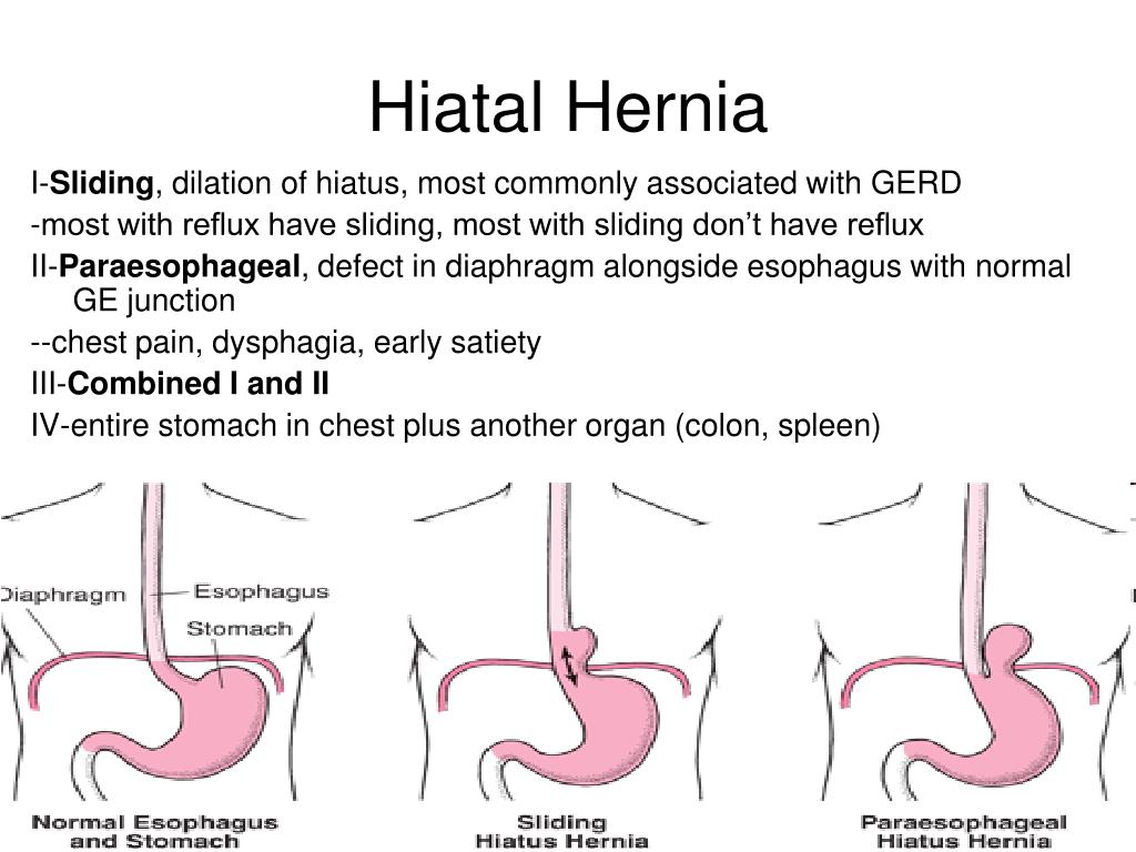 Sintomas hernia de hiato gases