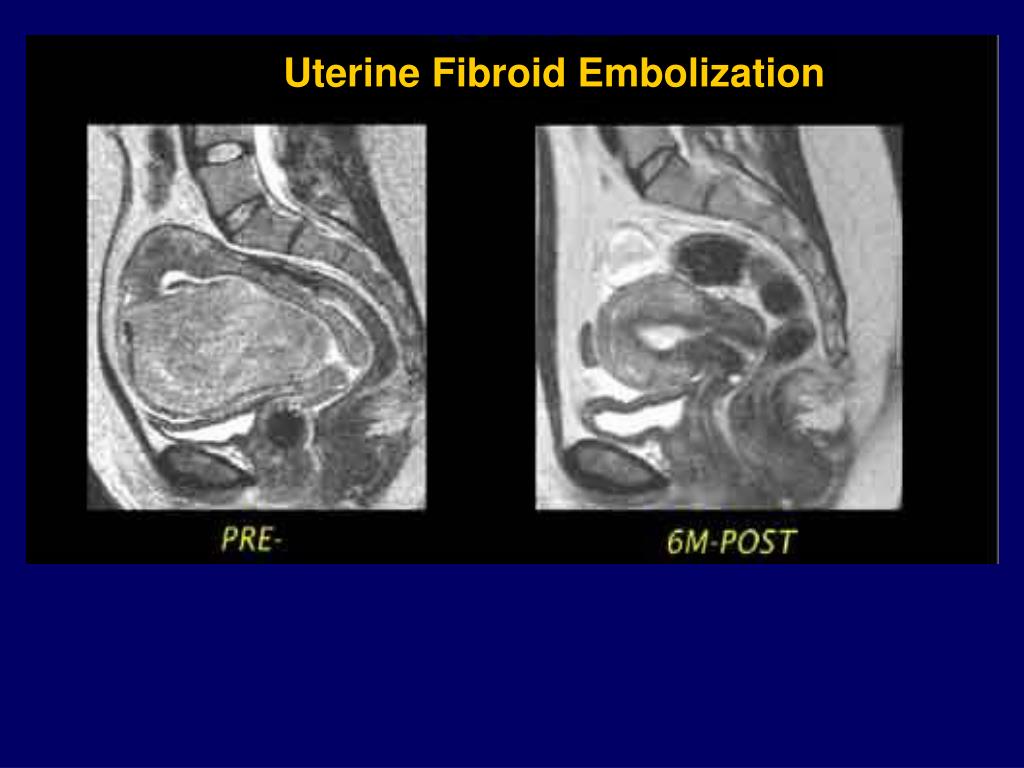 PPT Uterine Fibroid Embolization PowerPoint Presentation, free
