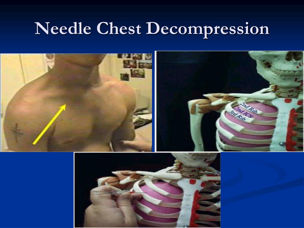 PPT Treating Open and Closed Chest Wounds PowerPoint Presentation