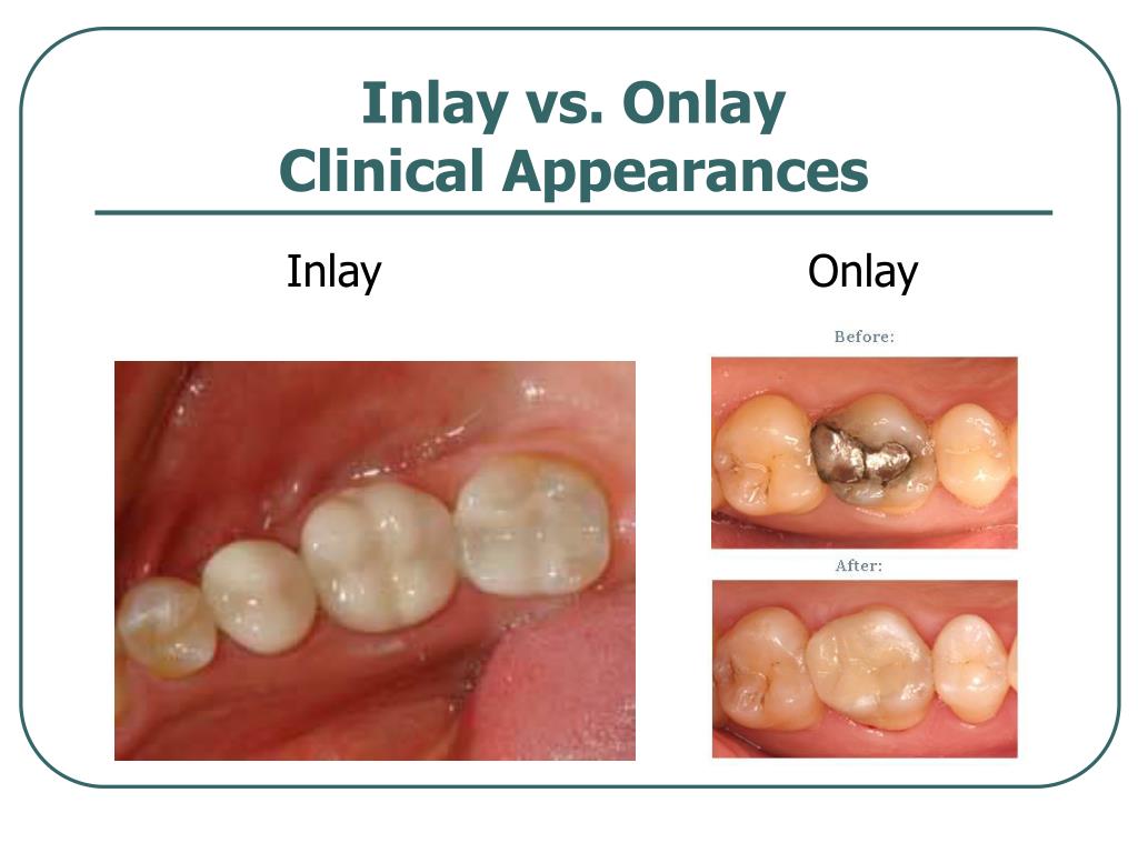 PPT Identifying and Charting Restorations PowerPoint Presentation, free download ID387047