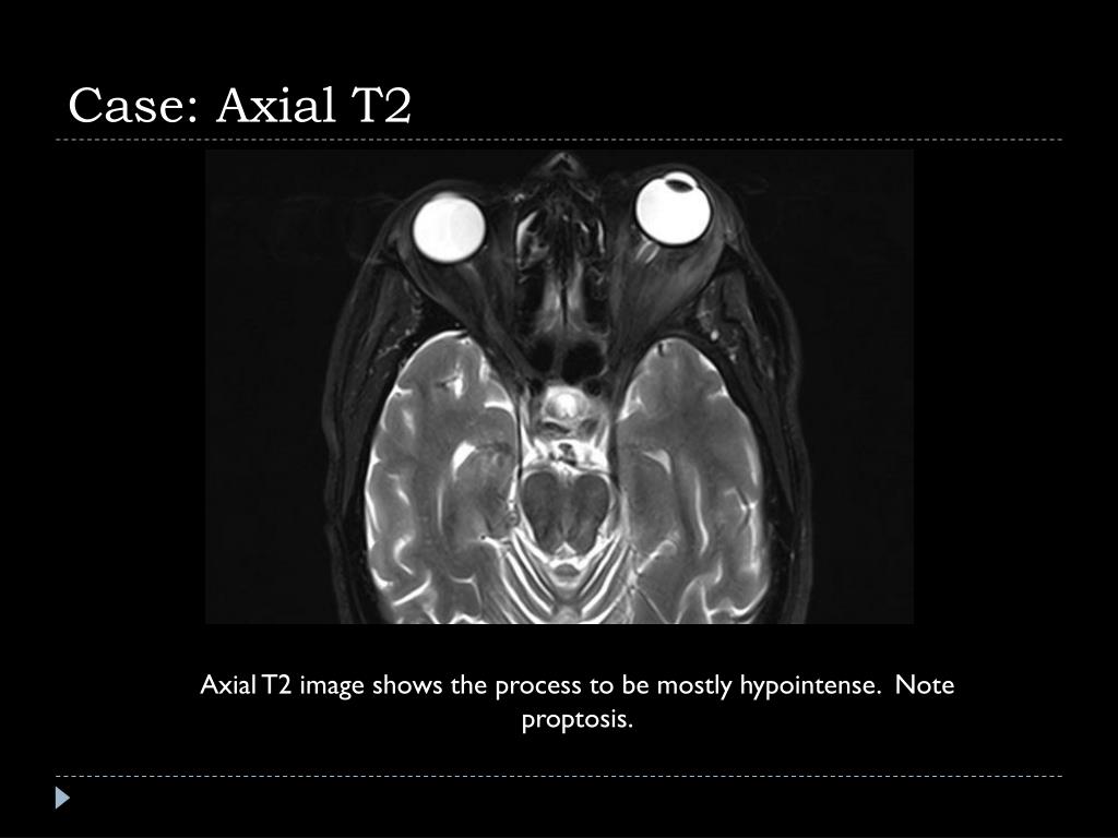 PPT Orbital Pseudotumor Idiopathic Orbital Inflammation PowerPoint