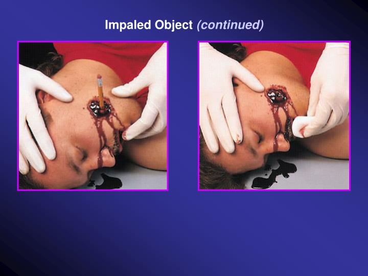 First Aid Measures For An Impaled Object The Y Guide