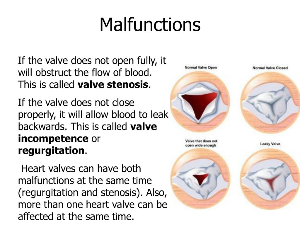 PPT - Aortic Valve Disease PowerPoint Presentation, free download - ID