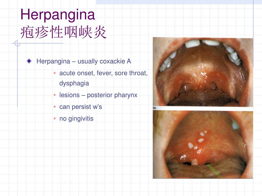 PPT Enteroviruses PowerPoint Presentation, free download ID391959
