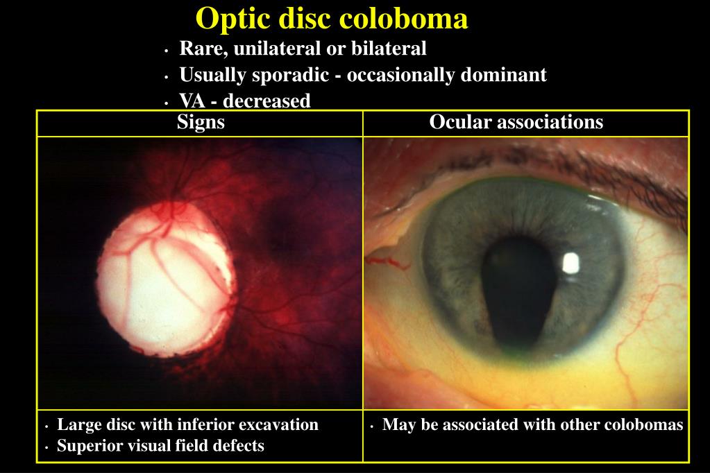 PPT CONGENITAL OPTIC NERVE ANOMALIES PowerPoint Presentation, free