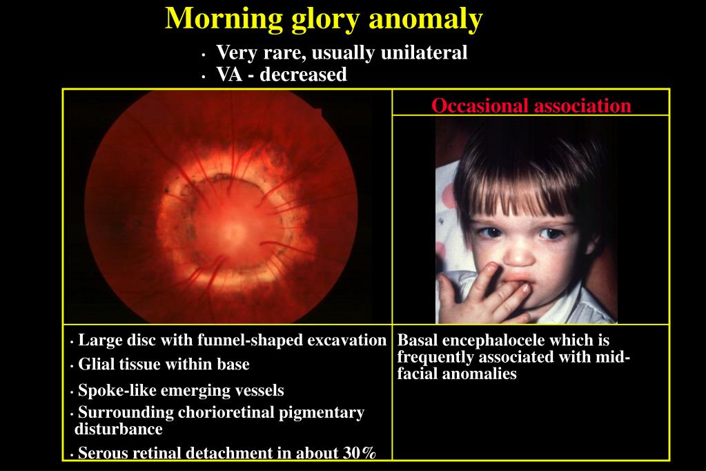PPT CONGENITAL OPTIC NERVE ANOMALIES PowerPoint Presentation, free