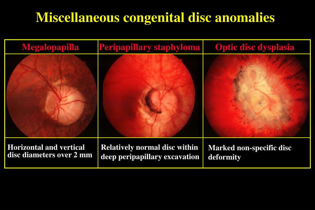 PPT CONGENITAL OPTIC NERVE ANOMALIES PowerPoint Presentation, free
