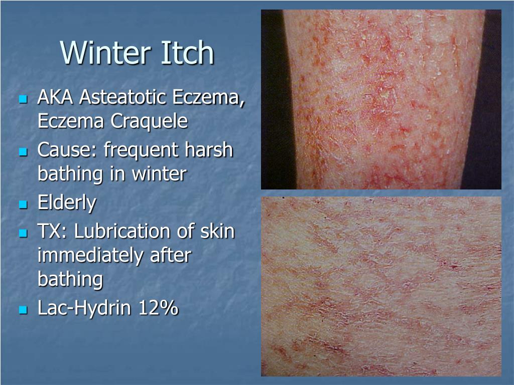 PPT Pruritus and Neurocutaneous Dermatoses PowerPoint Presentation