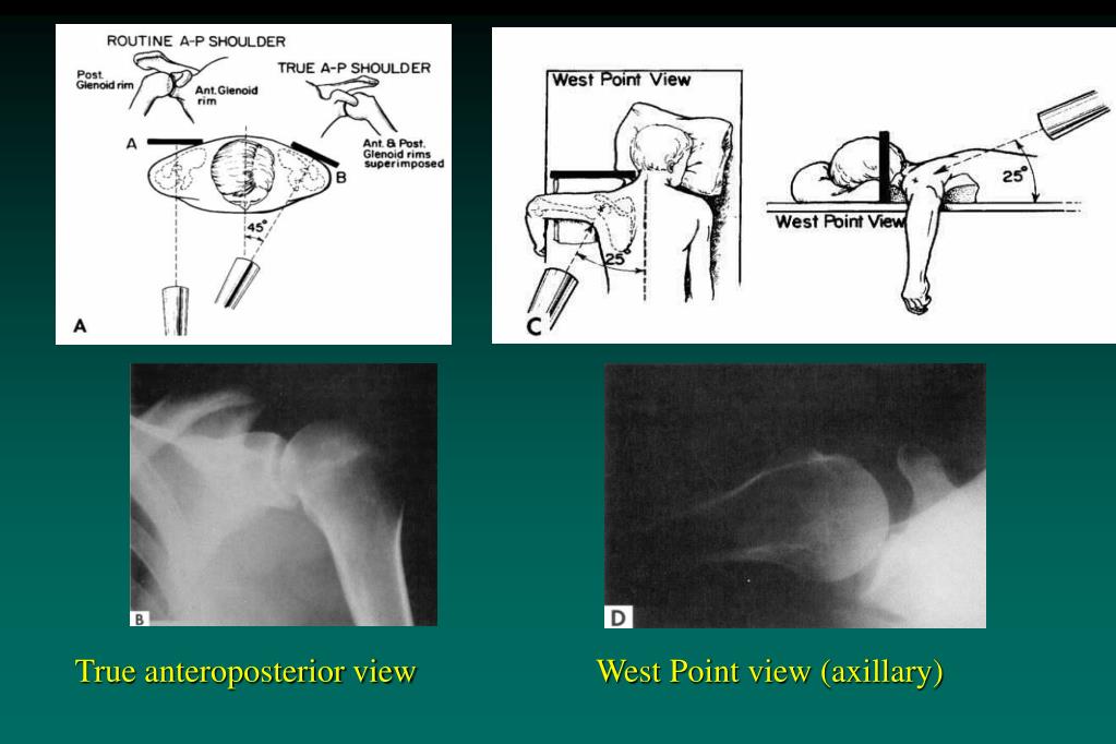 PPT Shoulder Instability PowerPoint Presentation, free download ID