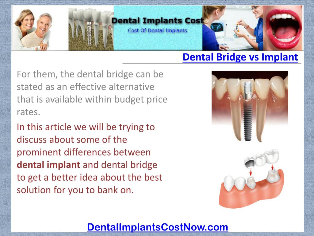 PPT Dental Bridge vs Implant PowerPoint Presentation, free download
