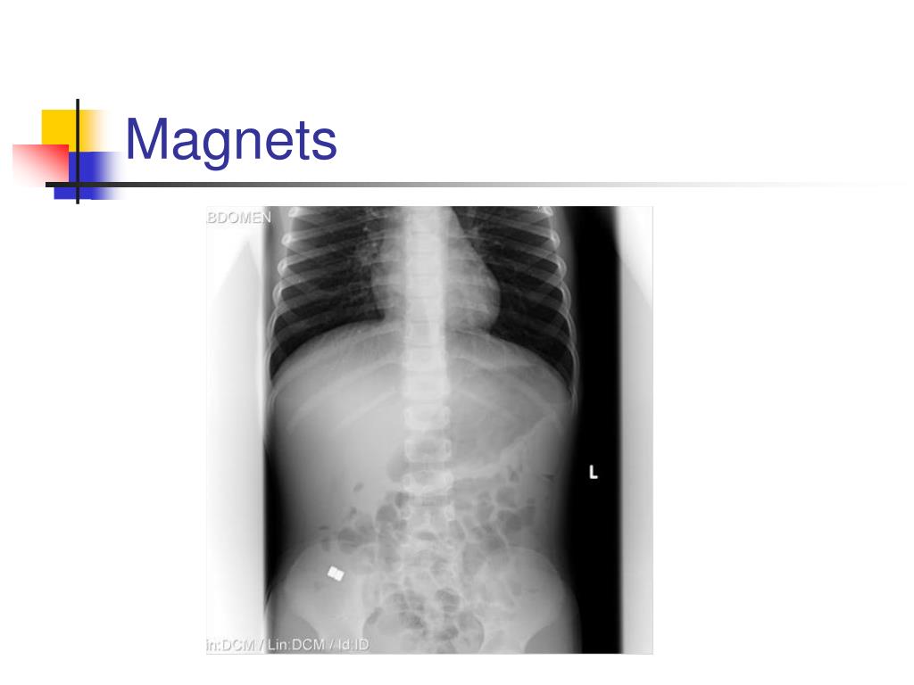 PPT Whoops Foreign Bodies on XRay PowerPoint Presentation, free