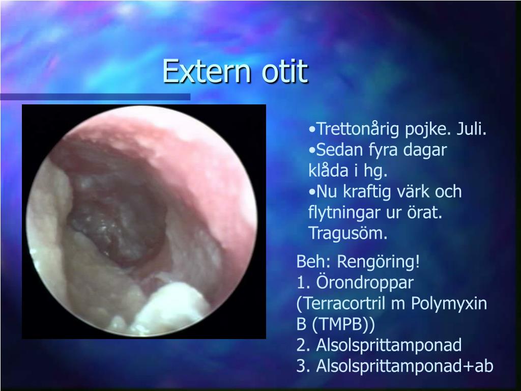 PPT Cecilia Ahlström Emanuelsson ÖNHkliniken, Lund PowerPoint