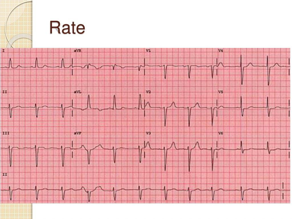 PPT ECG interpretation for beginners 1 PowerPoint Presentation