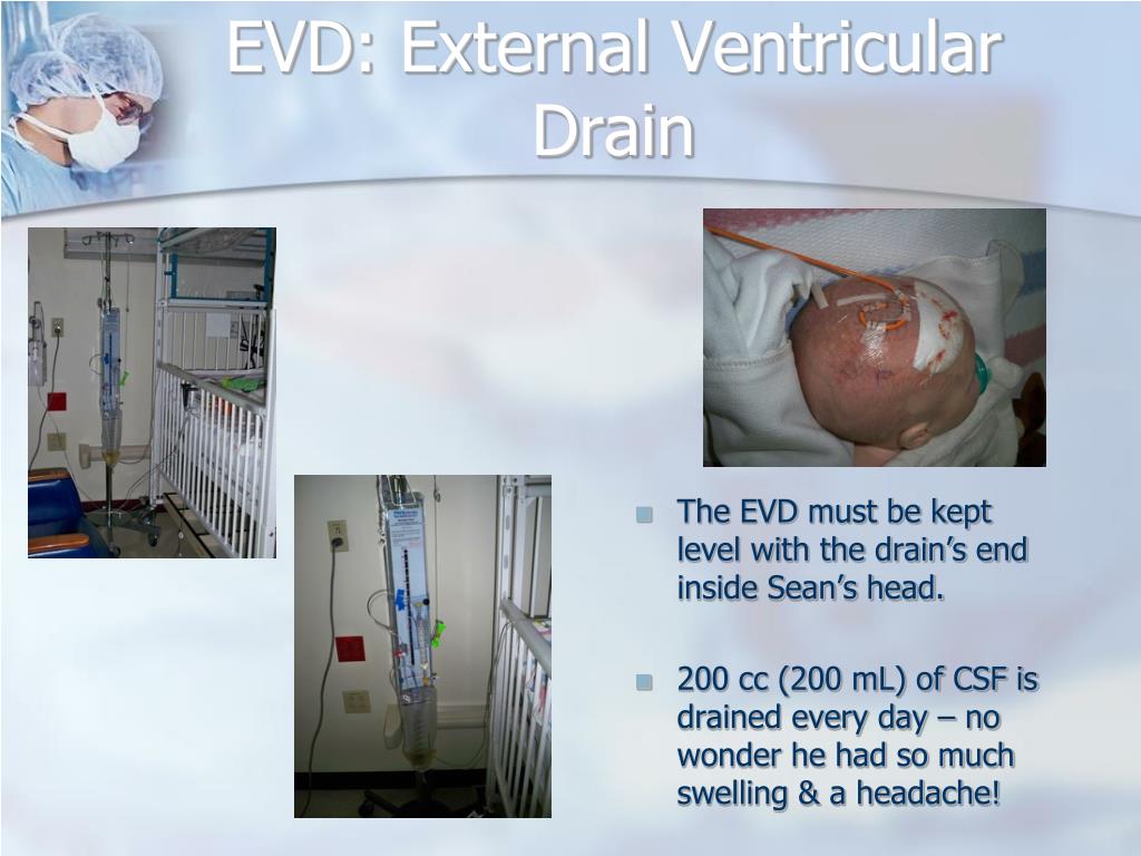 PPT Hydrocephalus & Shunts PowerPoint Presentation, free download ID431868