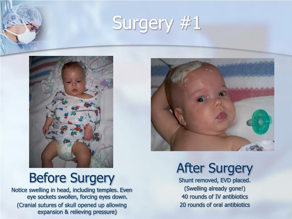 PPT Hydrocephalus & Shunts PowerPoint Presentation ID431868