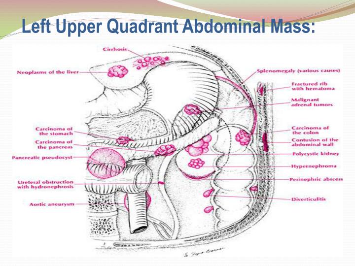 PPT Left Upper Quadrant Pain and Masses PowerPoint
