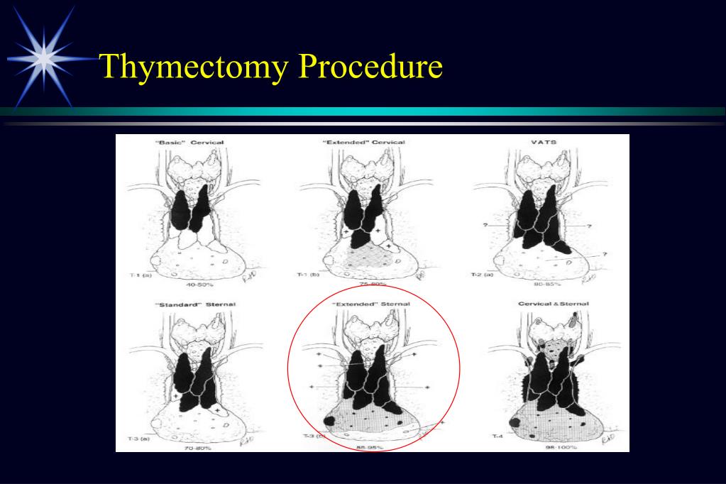 PPT Status of the Trial for Thymectomy in Nonthymomatous MG Patients