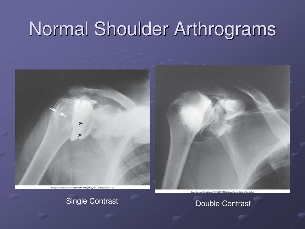 PPT Arthrography PowerPoint Presentation, free download ID443478