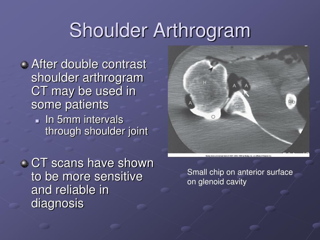 PPT Arthrography PowerPoint Presentation, free download ID443478