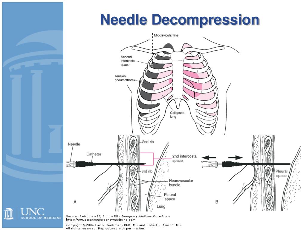 PPT Chest Pain PowerPoint Presentation, free download ID449344