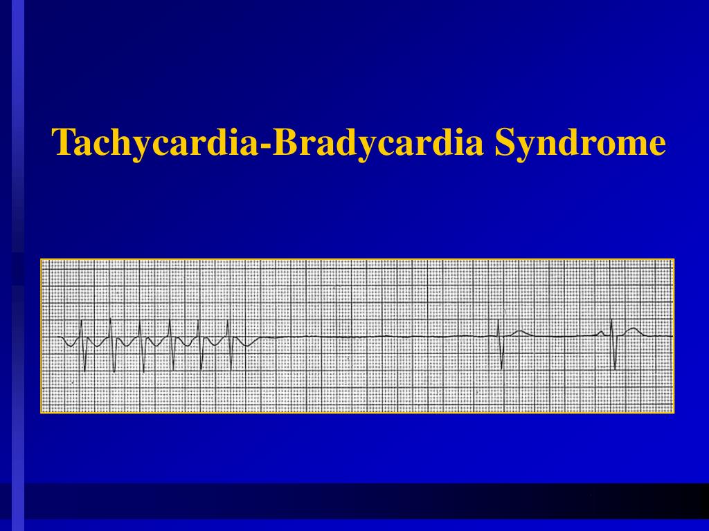 PPT Principles of Cardiac Pacing PowerPoint Presentation, free