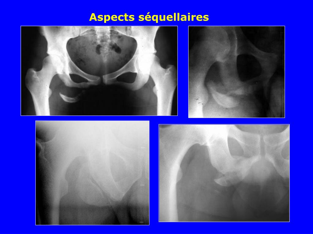 PPT Fractures du bassin PowerPoint Presentation, free download ID
