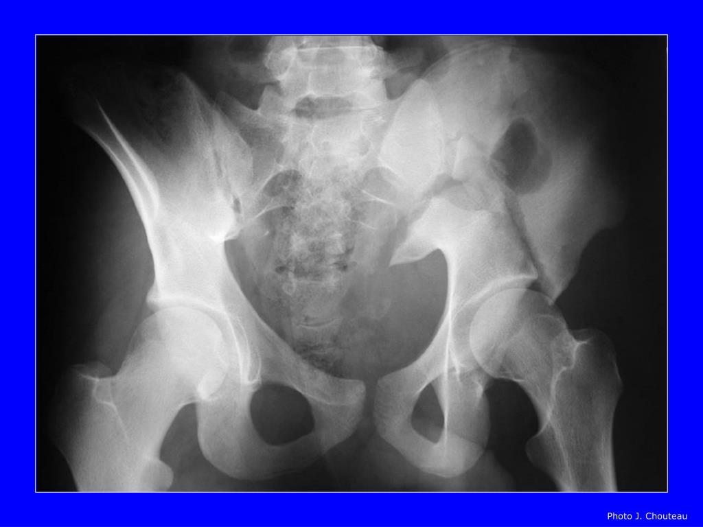 PPT Fractures du bassin PowerPoint Presentation, free download ID
