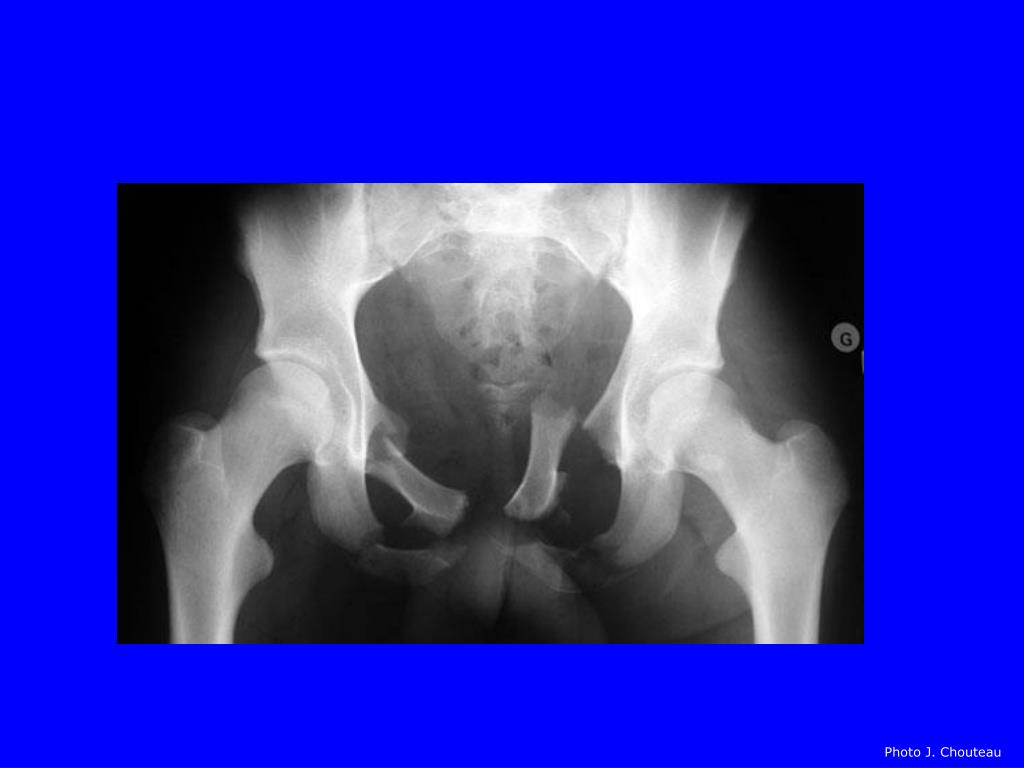 PPT Fractures du bassin PowerPoint Presentation, free download ID