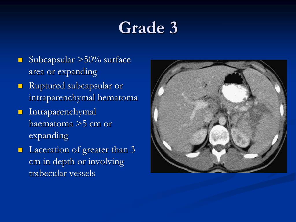 PPT JHSGR Management of blunt splenic injuries PowerPoint